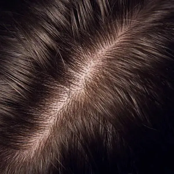 Minoxidil – Unterstützung bei Haarausfall: Was es kann und was Sie wissen sollten Minoxidil – Unterstützung bei Haarausfall: Was es kann und was Sie wissen sollten